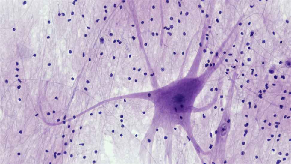 ALS is driven by a domino-like chain reaction that begins in nerve cells, research reveals
