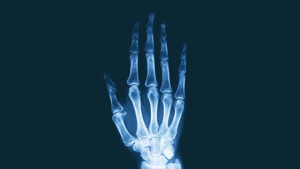 Immunovant Shares Surge on Arthritis Trial Data