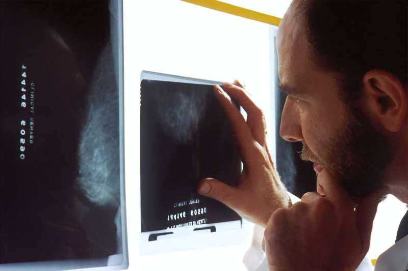 Q&A: Researcher Discusses Early-Onset Breast Cancer in East Africa
