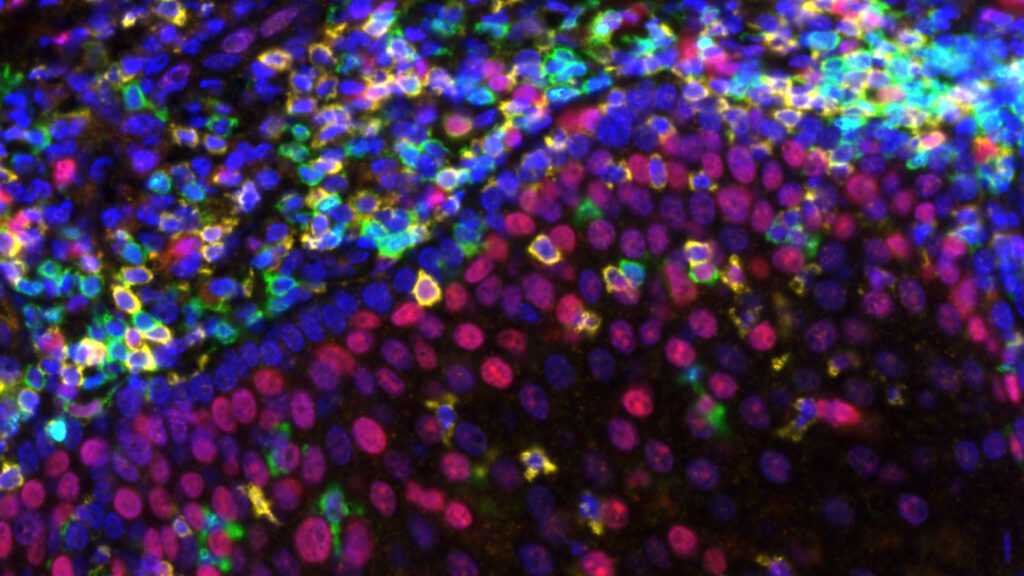 Ultra-low doses could bring costly cancer treatments to more patients in poorer countries
