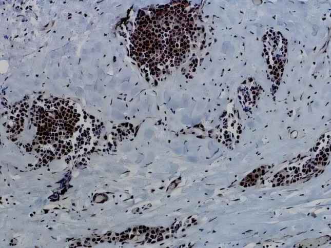 First comprehensive look at breast cancer in Native American women reveals key genetic differences
