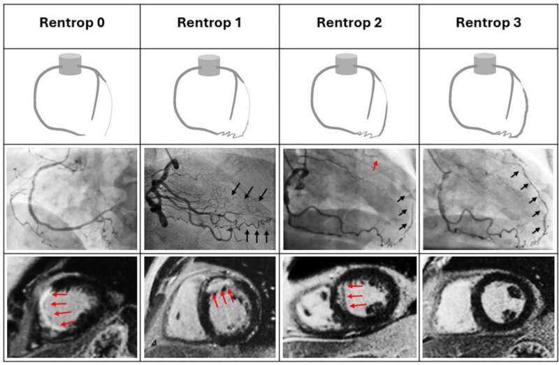 The Heart’s ‘Natural Bypass’ That Could Spare Patients from Risky Procedures