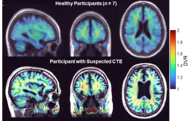 Researchers Discover Potential Biomarker for Chronic Traumatic Encephalopathy Using PET Imaging in Living Humans
