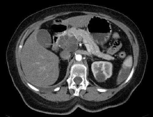 RAS(ON) Inhibitor Doubles Median Overall Survival in Metastatic Pancreatic Cancer Patients