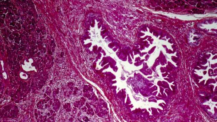 A turning point for pancreatic cancer patients