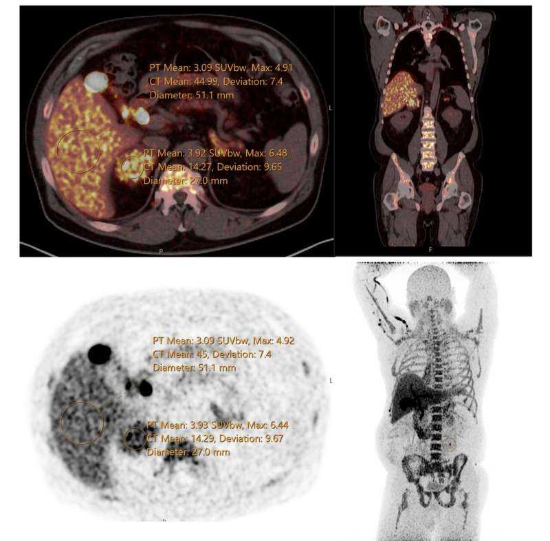 Novel Radiotracer Images Overactive Adrenal Glands Offering Non-Invasive Diagnosis for Primary Aldosteronism