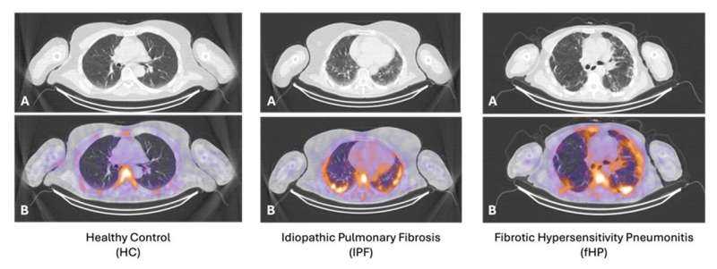 New SPECT/CT Technique Accurately Distinguishes Inflammation from Fibrosis in Lung Disease Patients