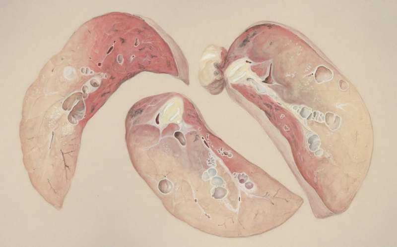 TP53 gene mutations affect lung cancer treatment response, study shows