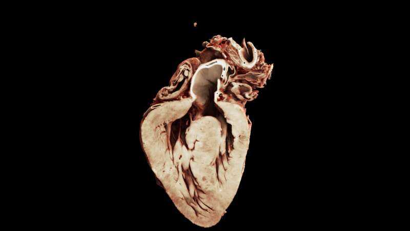 New 3D Map of Heart’s Electrical Wiring Offers Insights into Congenital Heart Disease