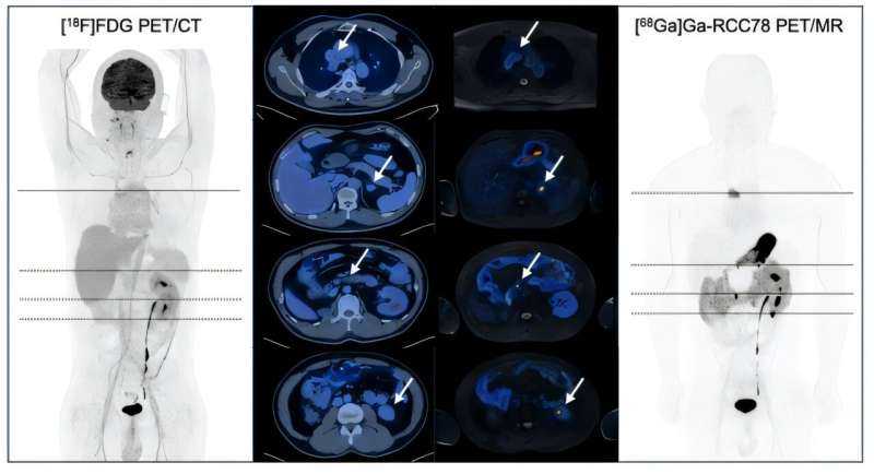 Next-generation PET Tracer Enables Rapid, High-precision Detection of Kidney Cancer