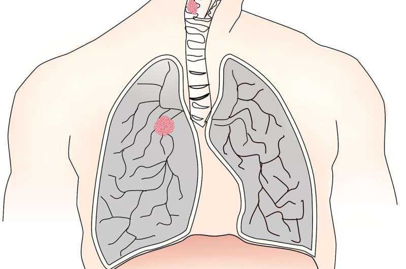 Targeted Therapy Reduces Risk of Lung Cancer Recurrence by 83% in Rare Genetic Subtype
