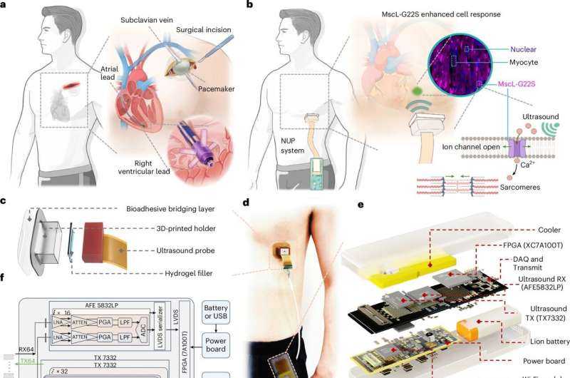 Ultrasound-based pacemaker noninvasively steadies the heart