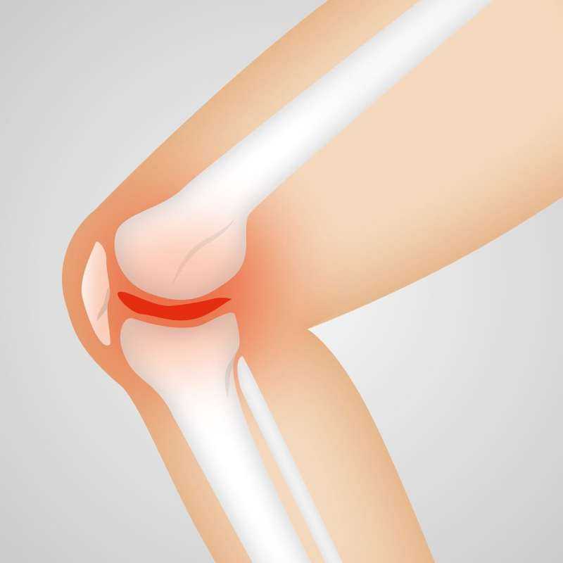 Largest Study Reveals Common Biological Pathways in Knee Osteoarthritis