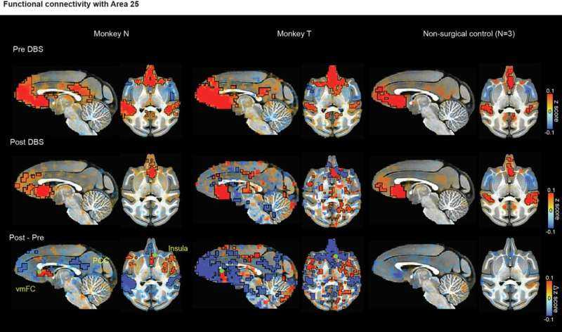 Deep Brain Stimulation Reveals New Mechanism Behind Depression Recovery