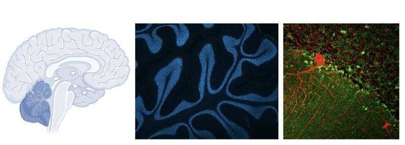 Potentially Reversible ALS Mechanism Changes Understanding of the Disease