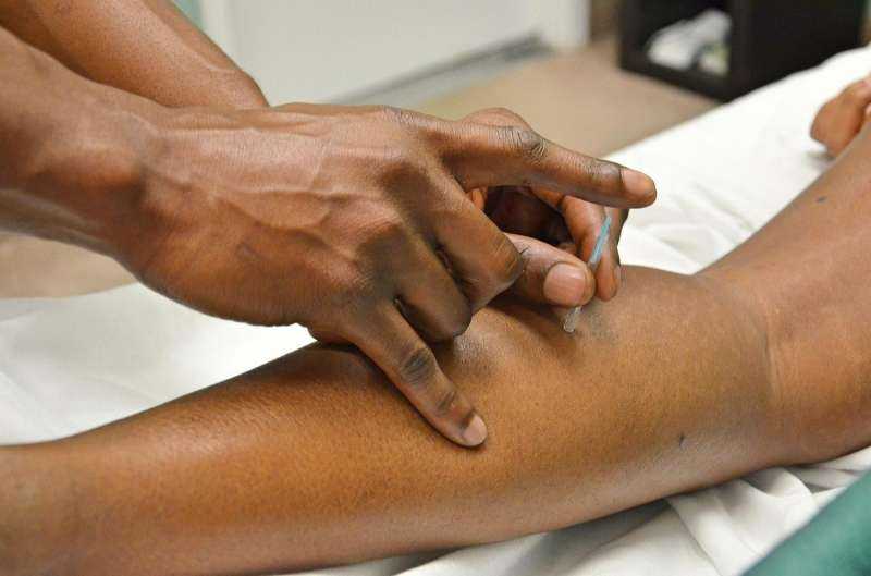 Acupuncture Could Enhance Motor Function Recovery Post-Stroke
