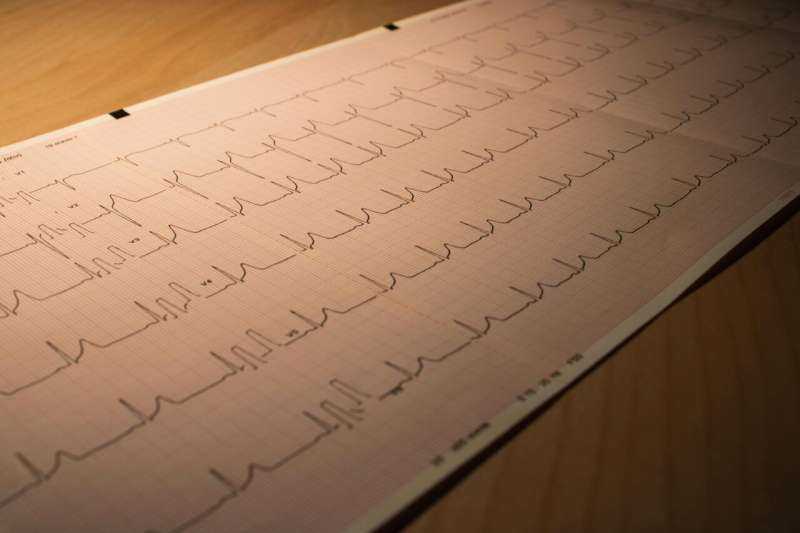 Researchers Challenge Assumption on Female Stroke Risk in Atrial Fibrillation Patients at Tulane University
