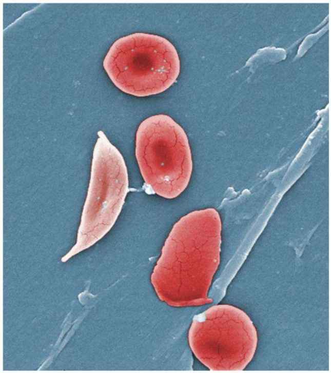 Life-changing Benefits of Hydroxyurea for Sickle Cell Anemia Confirmed by 10-Year Study